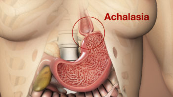 3D Medical Animation still showing Achalasia
