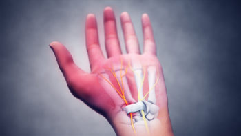 3D Medical Animation Still Depicting Carpel tunnel