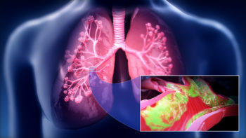 Medical animation still showing CHRONIC OBSTRUCTIVE PULMONARY DISEASE