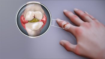 3D Medical Animation Showing RHEUMATOID ARTHRITIS
