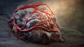 3D medical animation still showing malignant tumor.