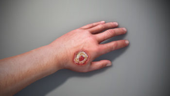 3D Medical Animation Still Depicting Skin Ulcer