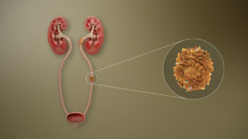 3D medical animation still showing Ureteral stones.