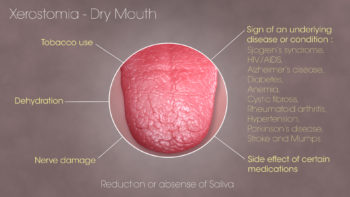 3D Medical Animation still showing Xerostomia