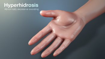 3D Medical Animation Still Showing Hyperhidrosis