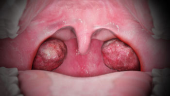 3D Medical Animation still showing Tonsillitis