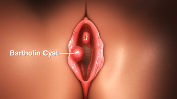 3D Medical animation still of bartholin cyst