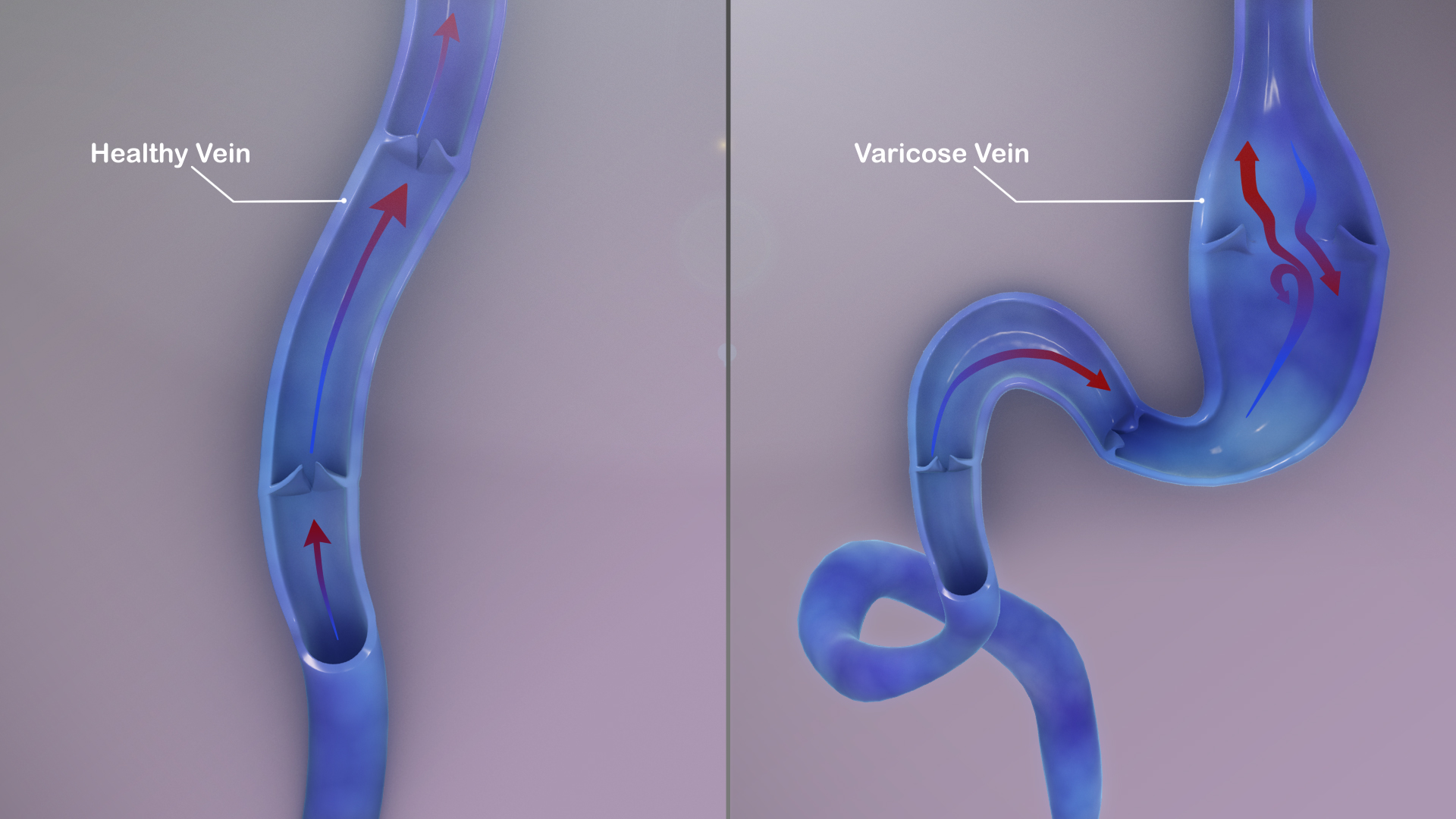 Varicose veins: Symptoms, Causes, and Treatment - Scientific Animations.