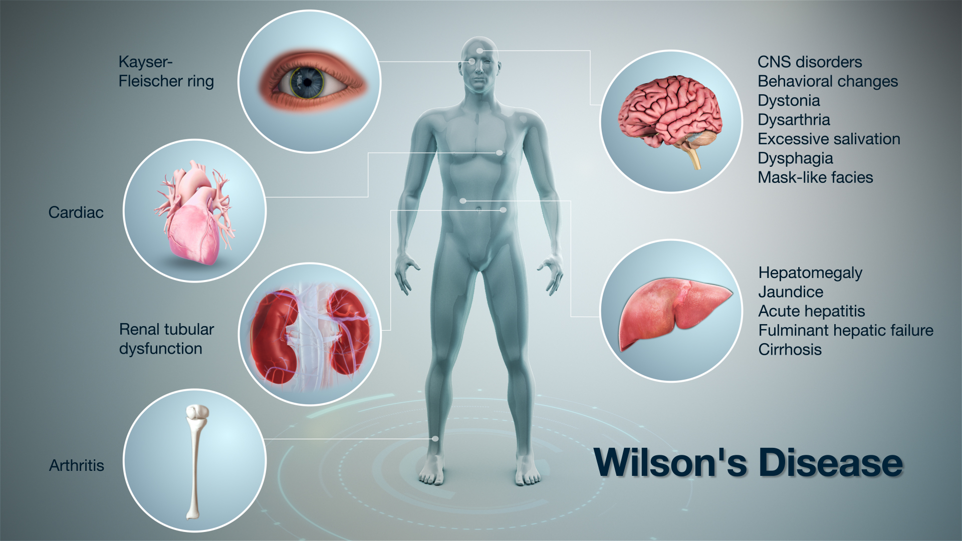 3D Medical Animation depicting Wilson's Disease