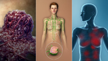 3D Medical Illustration depicting the TNM Stages in breast cancer