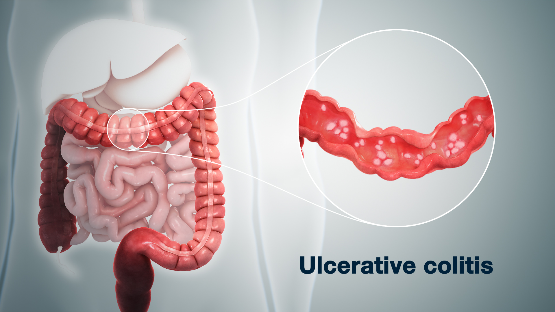 Ulcerative Colitis Causes & Treatment depicted using 3D medical aniamion