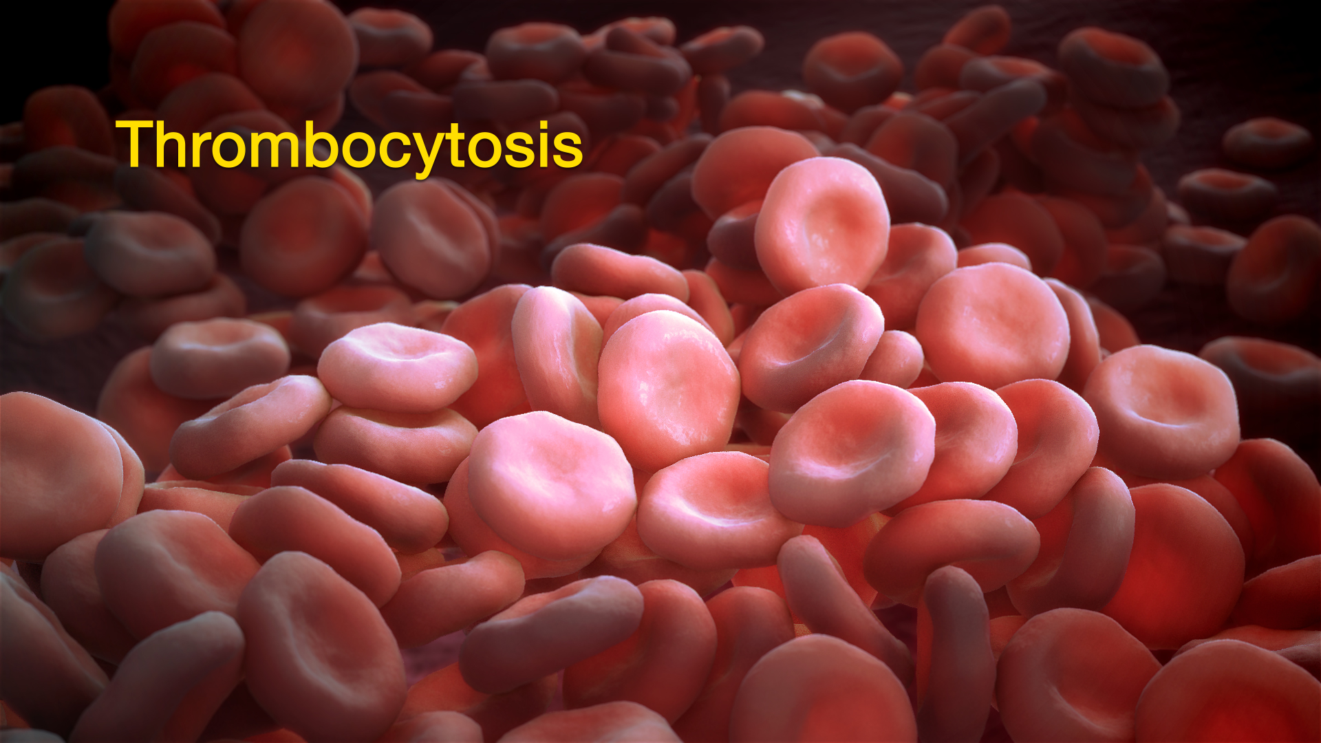 Thrombocytosis, as visualised by a 3D Medical Illustration
