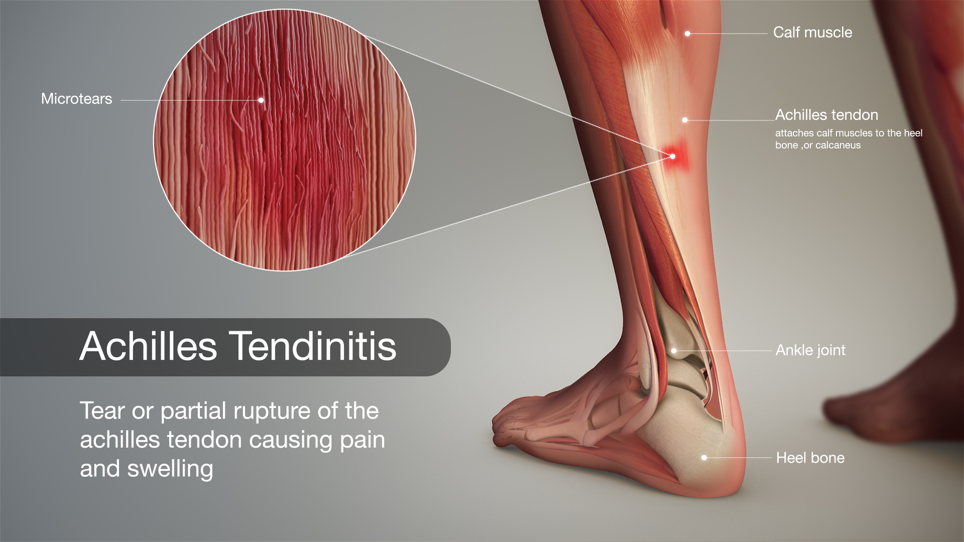 Achilles Tendon Pain (Partial Tear) - YouTube