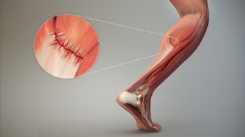 3D medical animation showing tore muscle fibers.