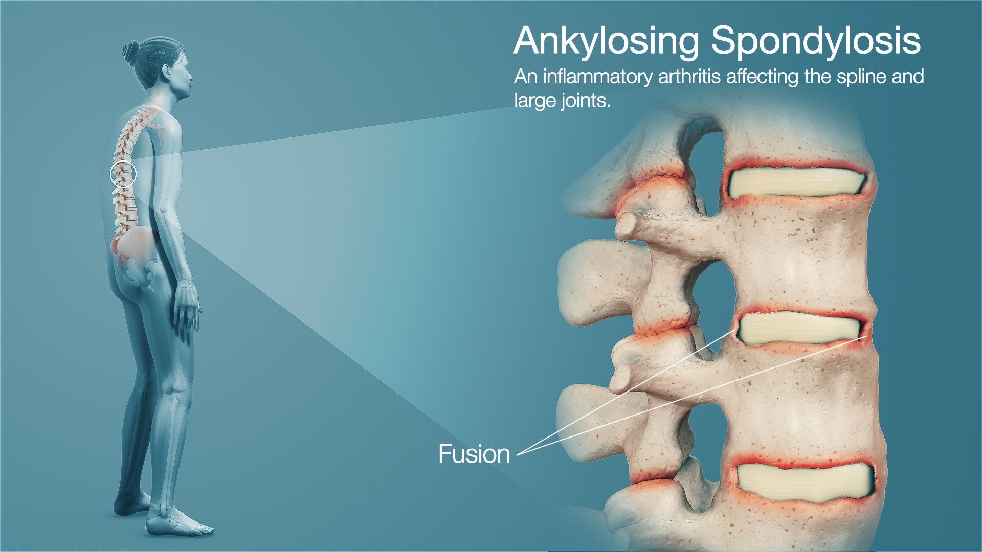 Ankylosing Spondylitis depicted by 3D medical animation & explained.