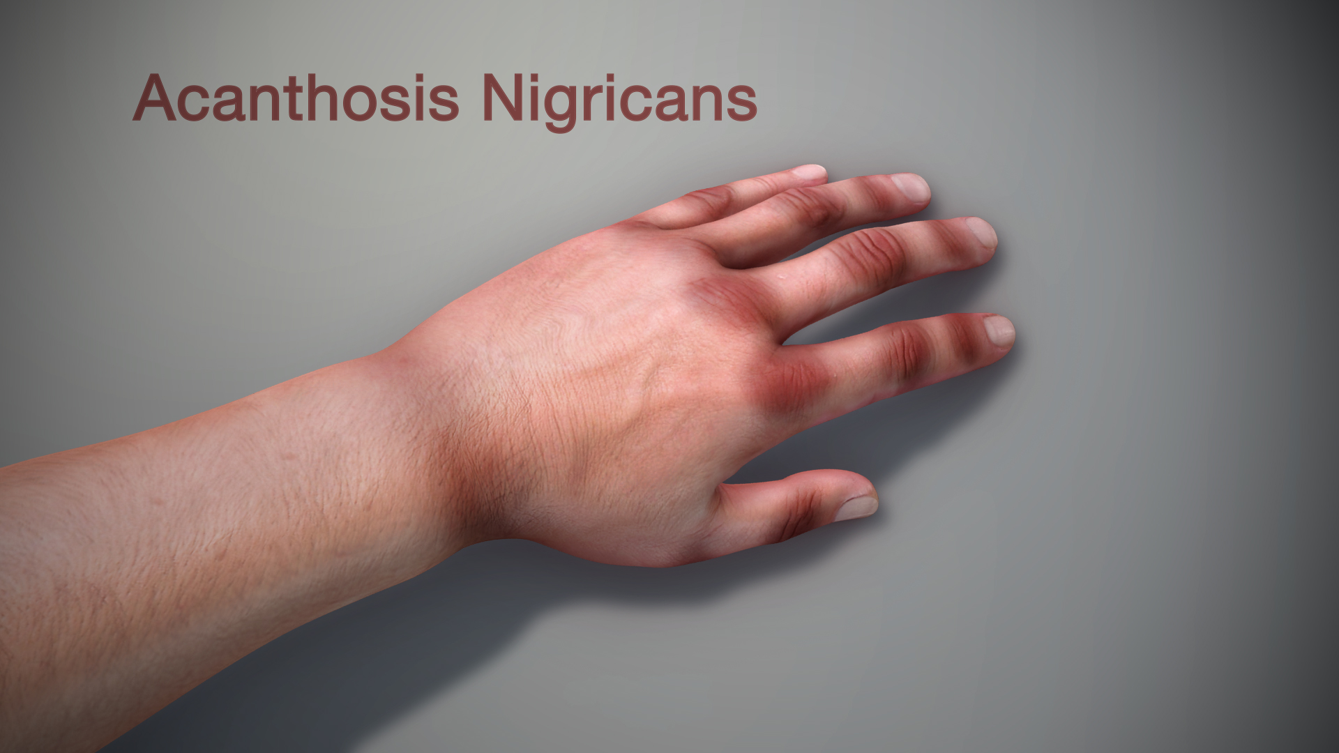 3D medical animation showing of Acanthosis Nigricans in human hand