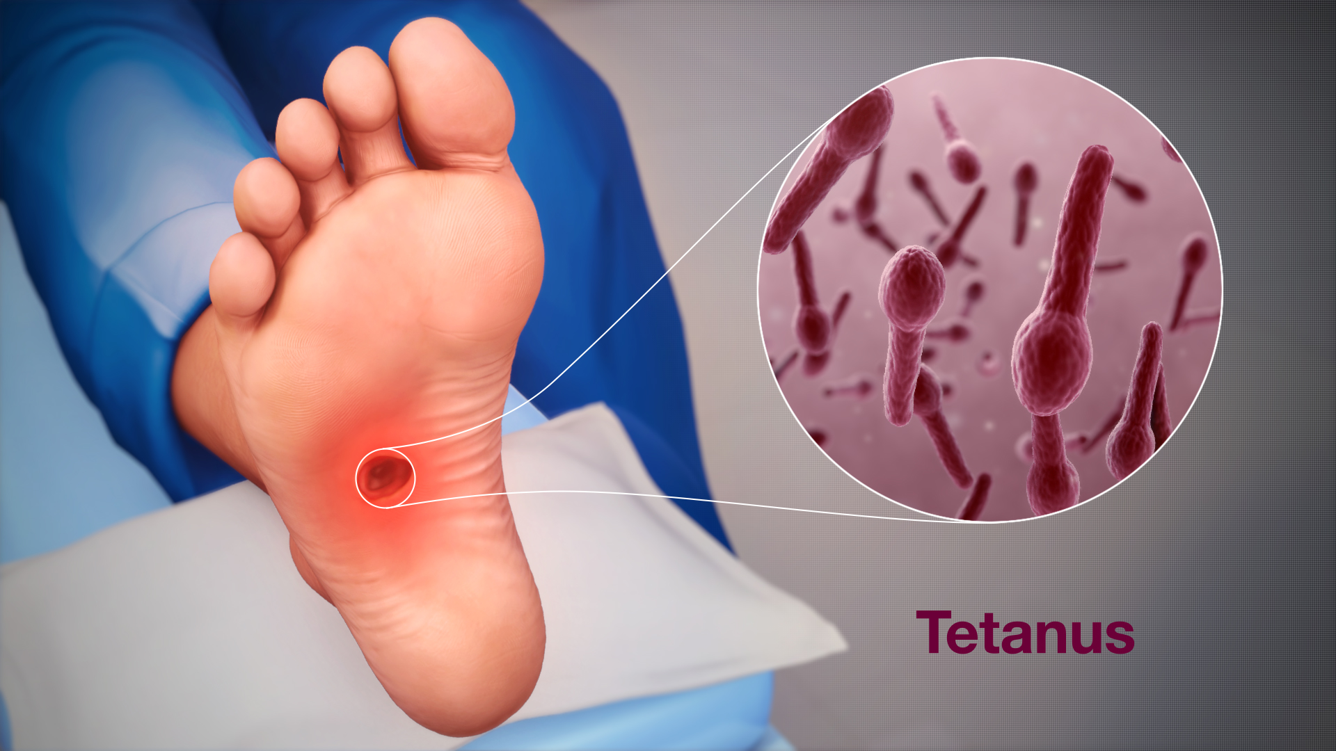 3D medical animation of tetanus in the human foot