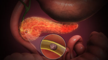 3D Medical Animation still shot of Acute Pancreatitis