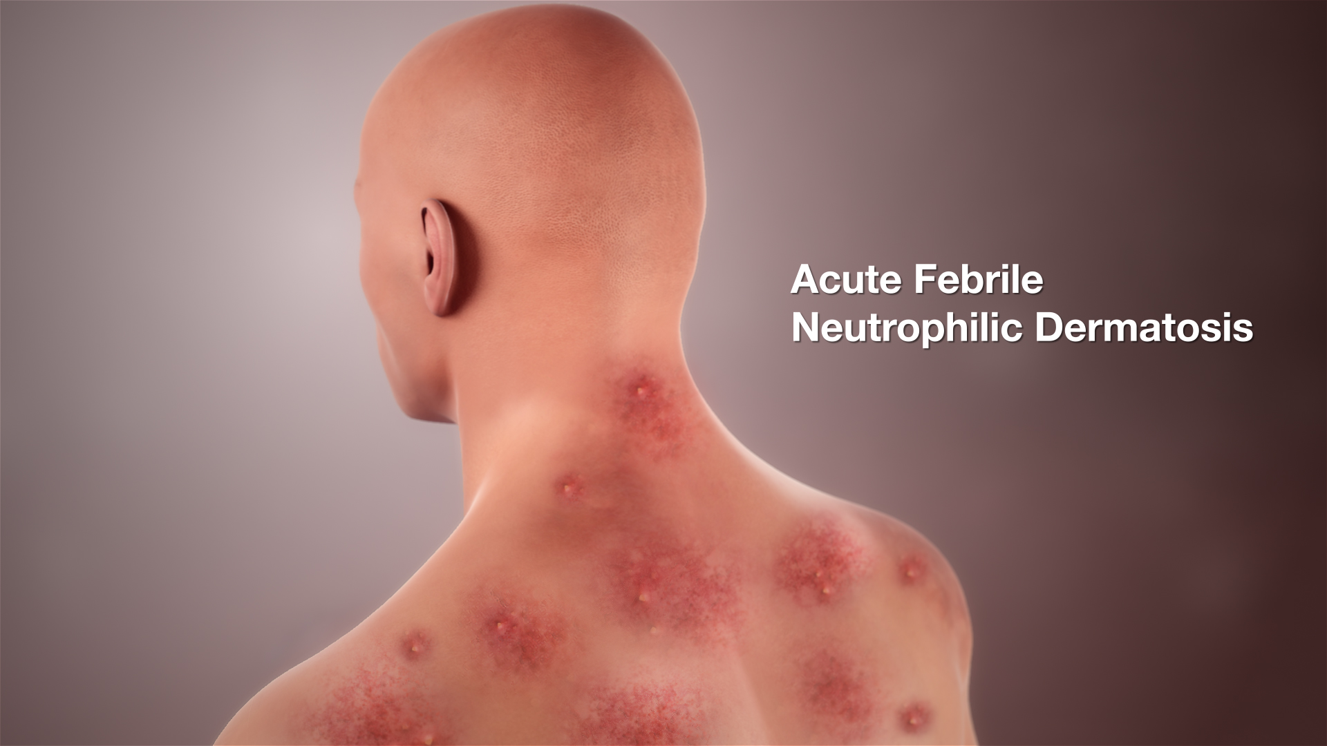 Medical animation still shot showing Acute Febrile Neutrophilic Dermatosis