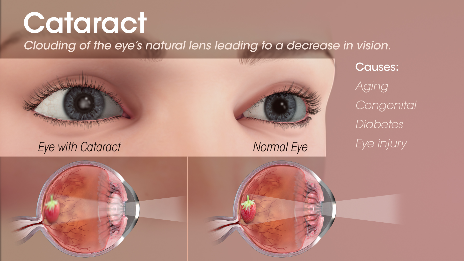 Medical Animation still showing eyes with & without Cataract