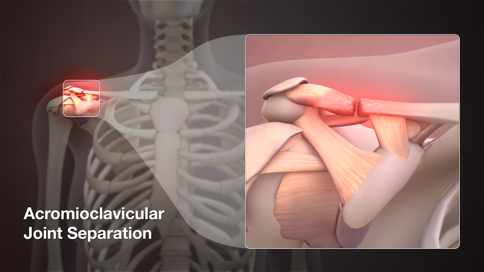 Medical Animation Still Shot showing Acromioclavicular Joint Separation