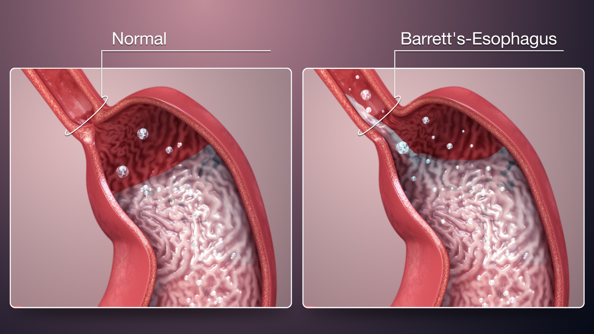 3D medical animation showing Barrett's Esophagus