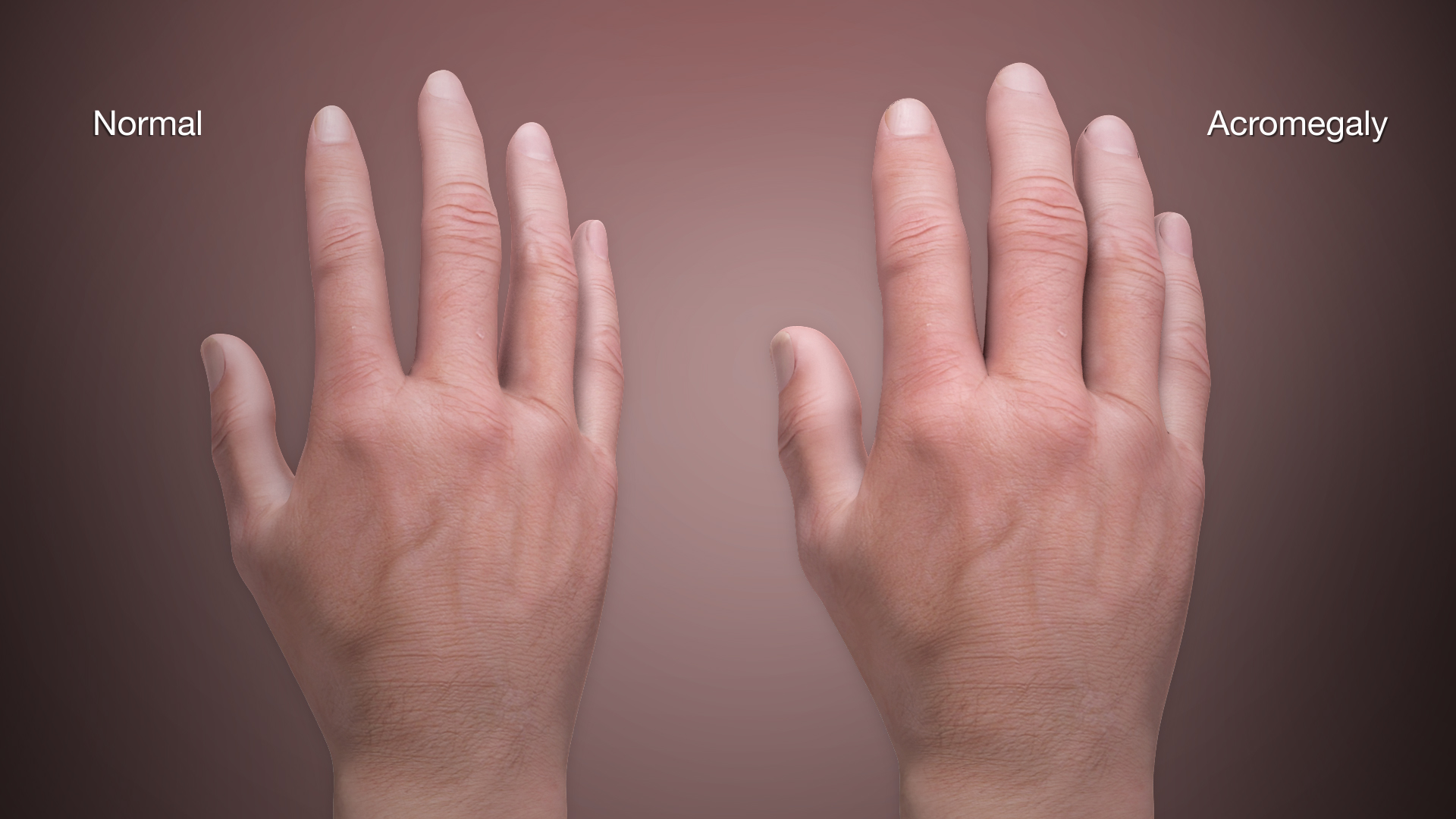 Medical Animation Still shot showing Acromegaly.