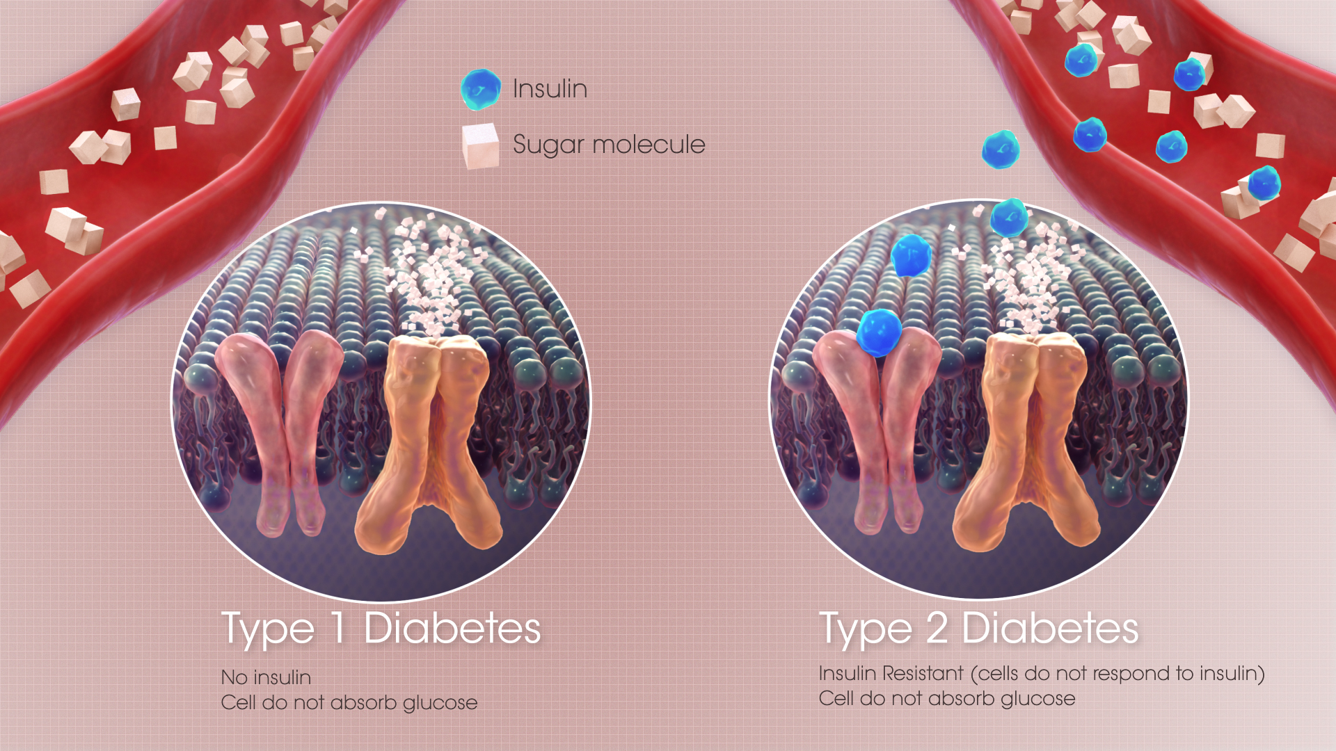 Medical Animation Showing Difference Between Type-1 & Type-2 Diabetes