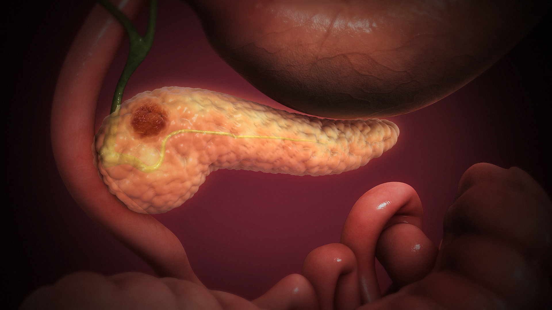 3D Medical Animation Still Shot Showing Pancreatic Cancer
