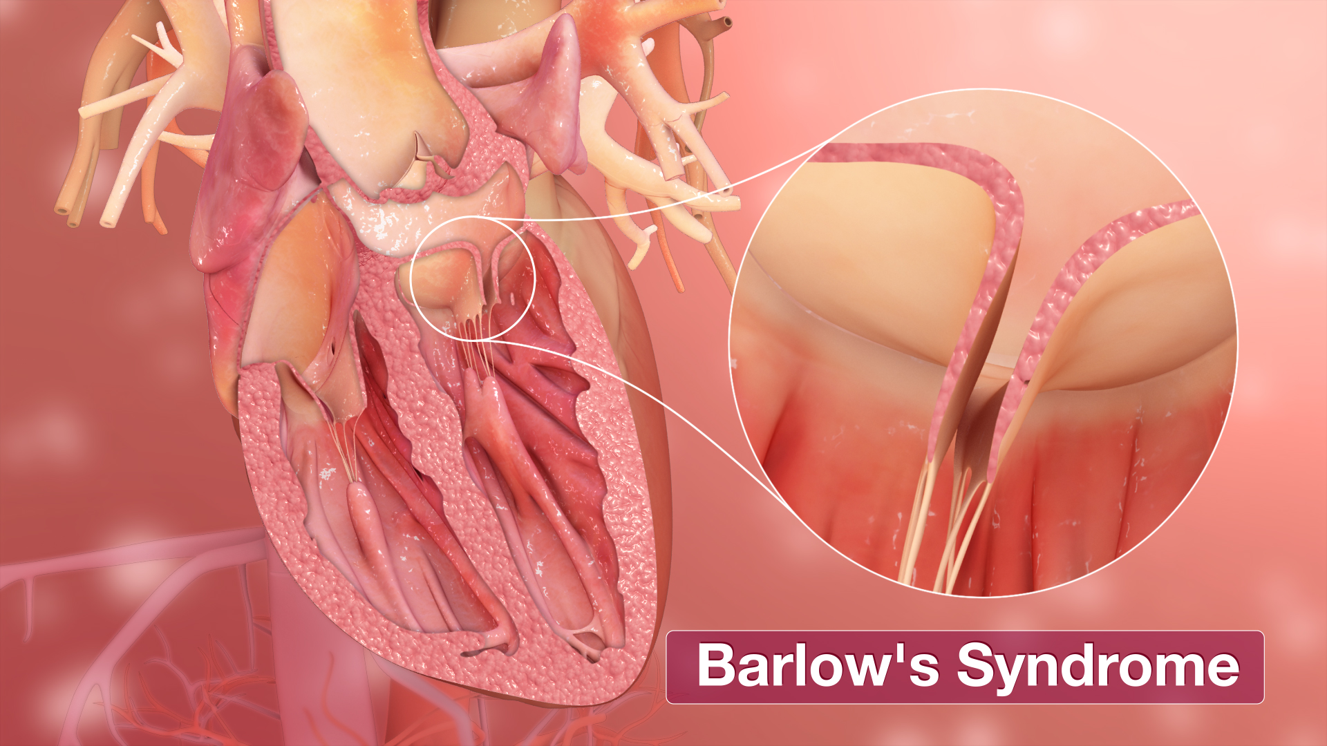 Barlow's-Syndrome medical animation still shot