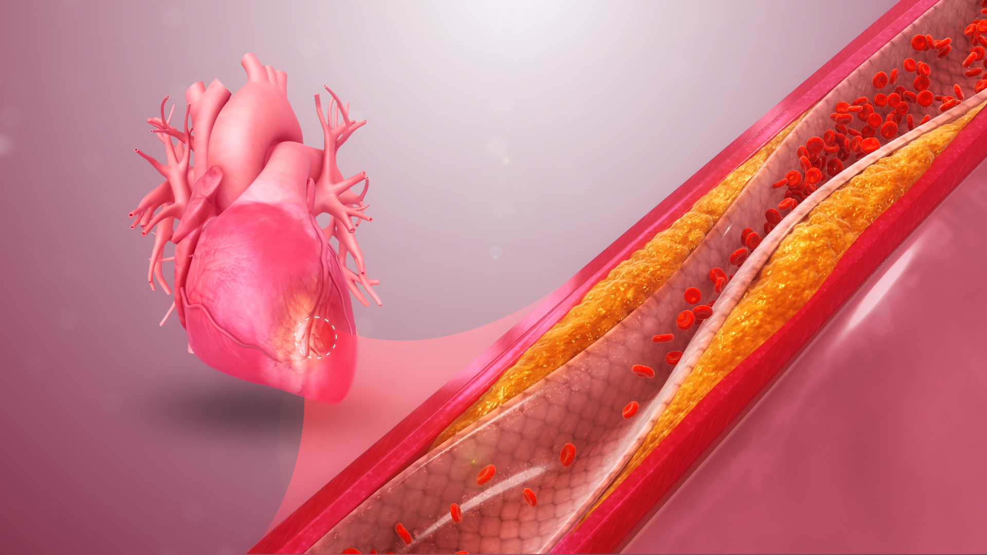 Medical Animation Still Shot Showing Acute Coronary-Artery-Disease