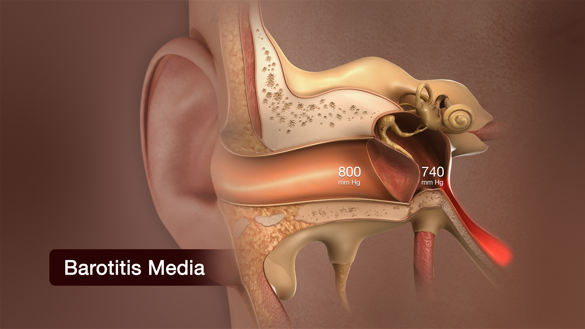 3D medical animation still shot showing Barotitis Media