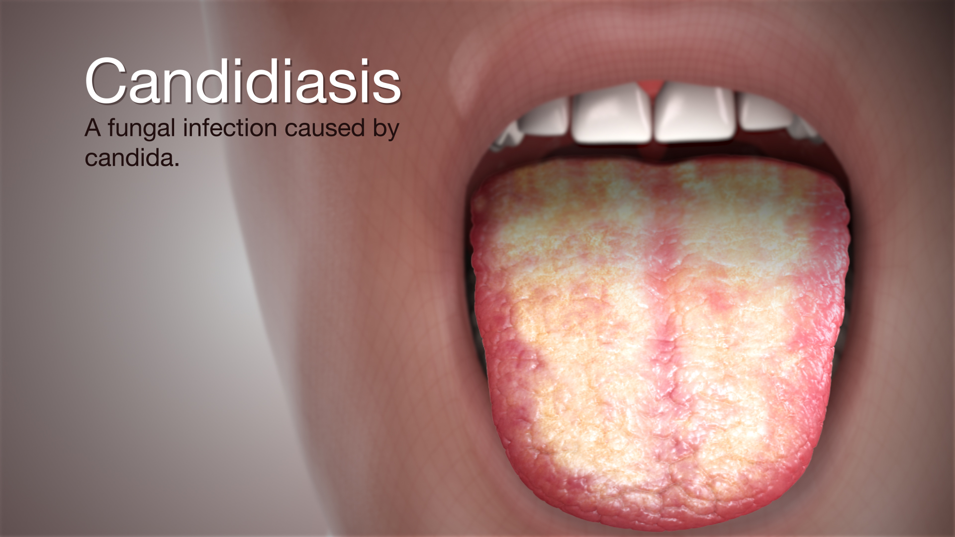 medical animation still shot showing Candidiasis