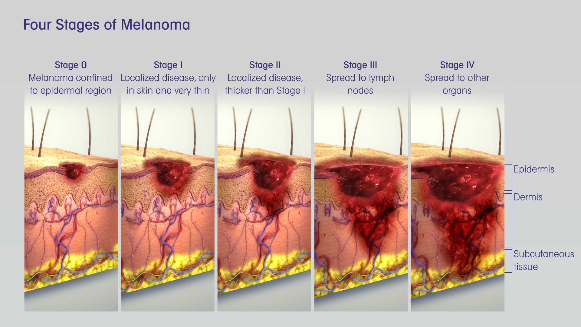 3D Medical Animation Showing Different Stages of Melanoma Skin Cancer