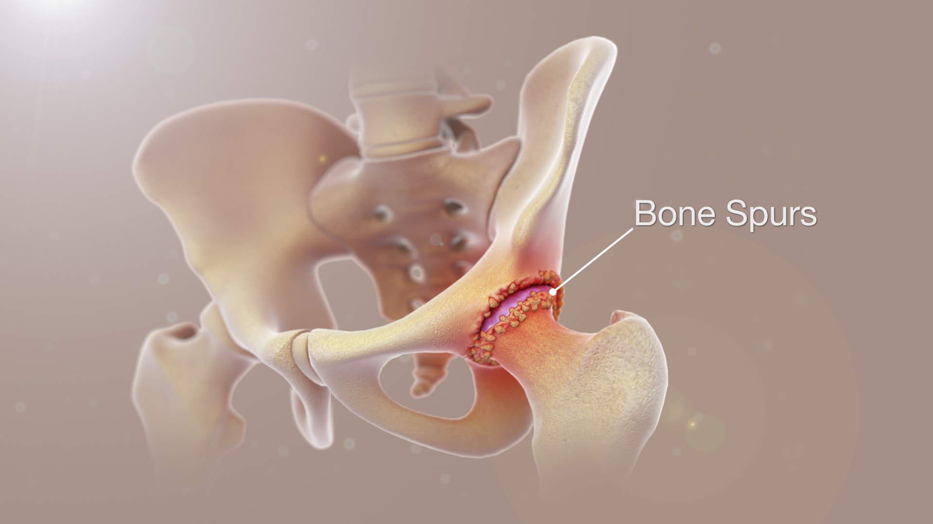 Medical Animation Still Shot Showing Bone Spurs