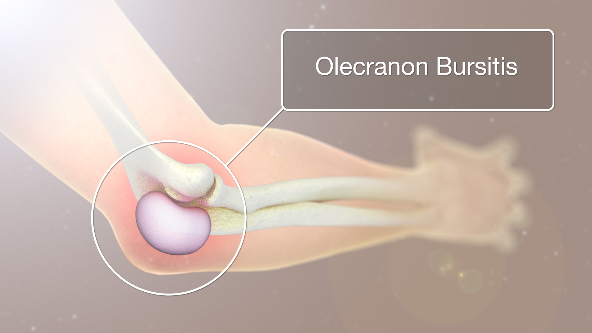 Olecranon Bursitis shown and explained using medical animation still shot