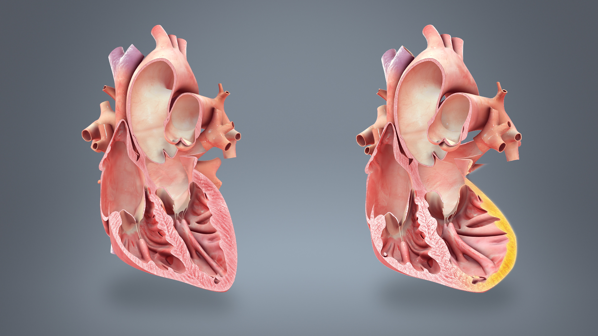 medical animation still shot showing a normal heart and a heart on the verge of Heart-Failure