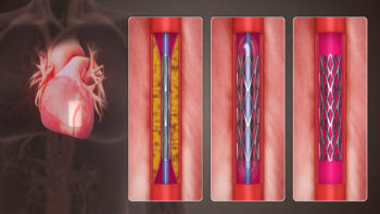 3D Medical Animation Percutaneous coronary intervention