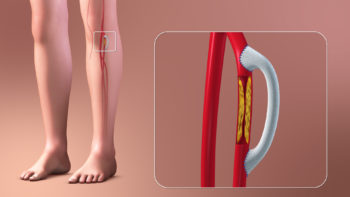 3D Medical Animation Vascular Bypass Grafting