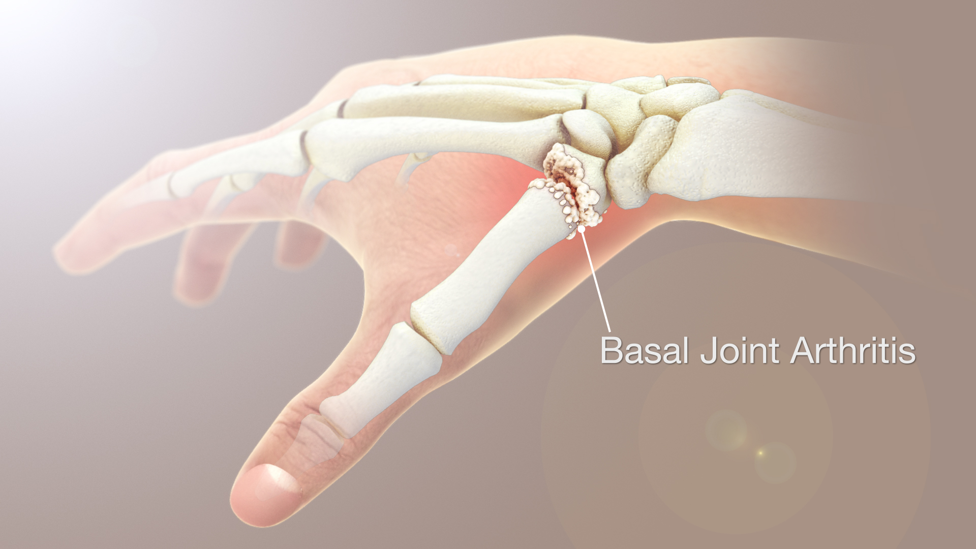 Basal Joint Arthritis Shown & Explained Using Medical Animation Still Shot