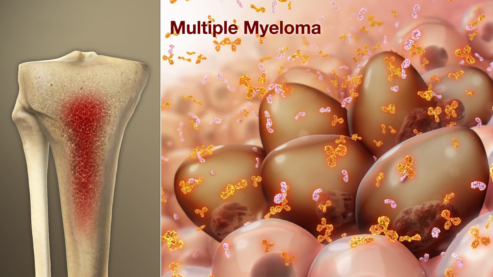 Medical Animation Still Shot Showing Multiple-Myeloma