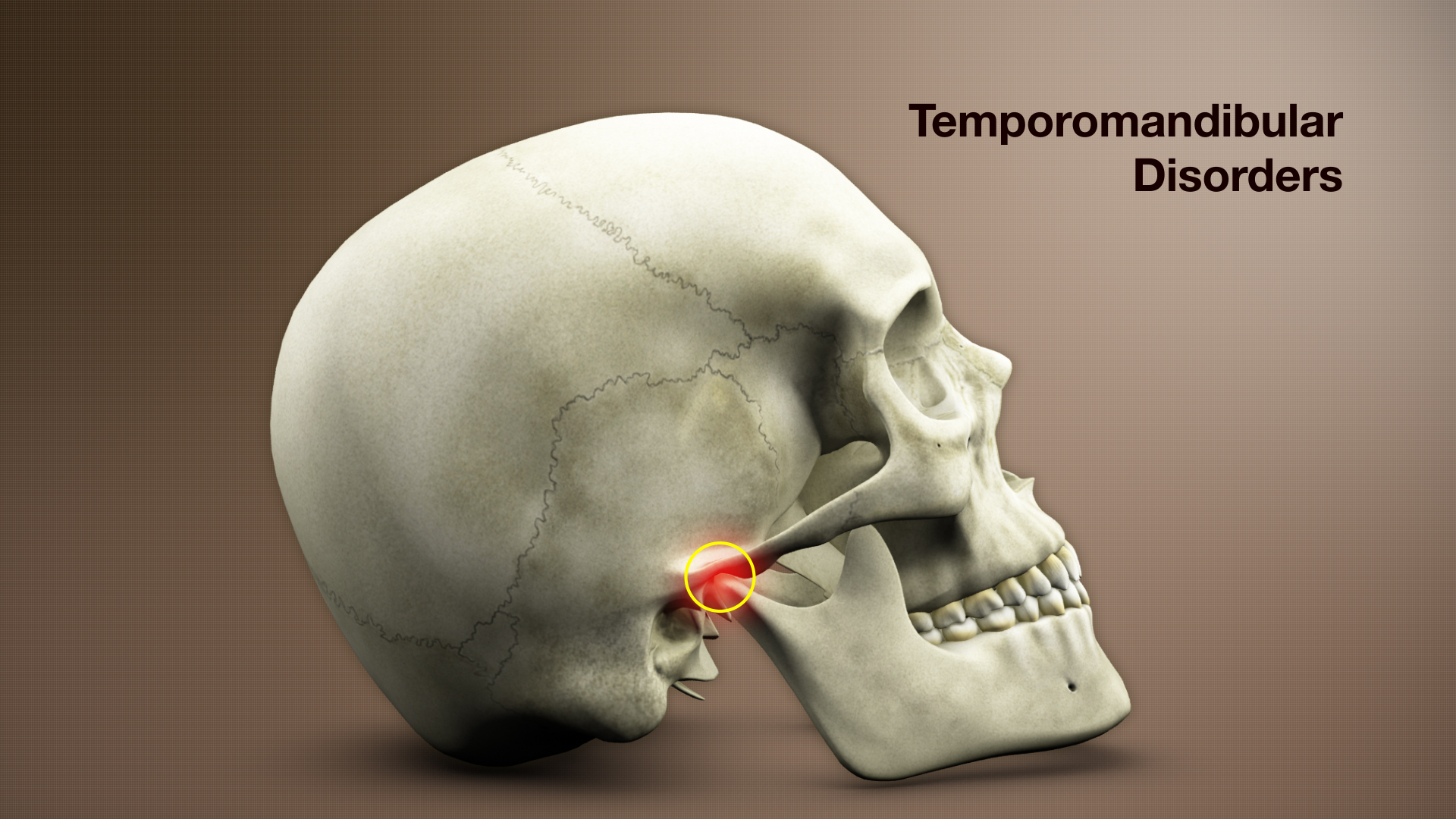 Temporomandibular joint disorder shown using medical animation still shot