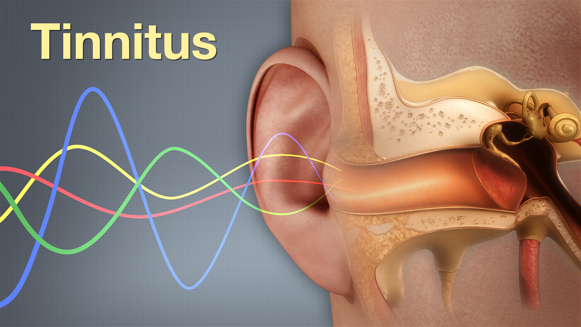 Medical animation still shot showing Tinnitus