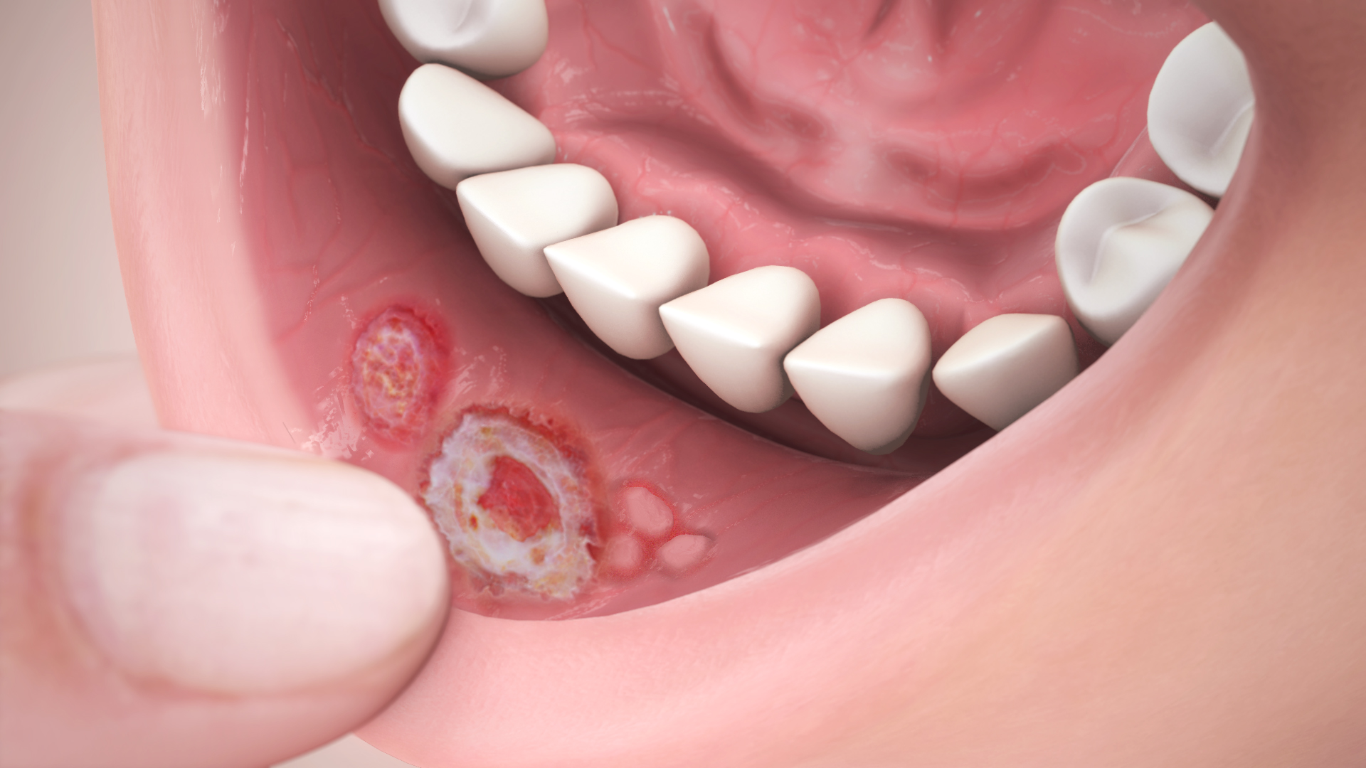 Medical animation still shot showing aphthous ulcers