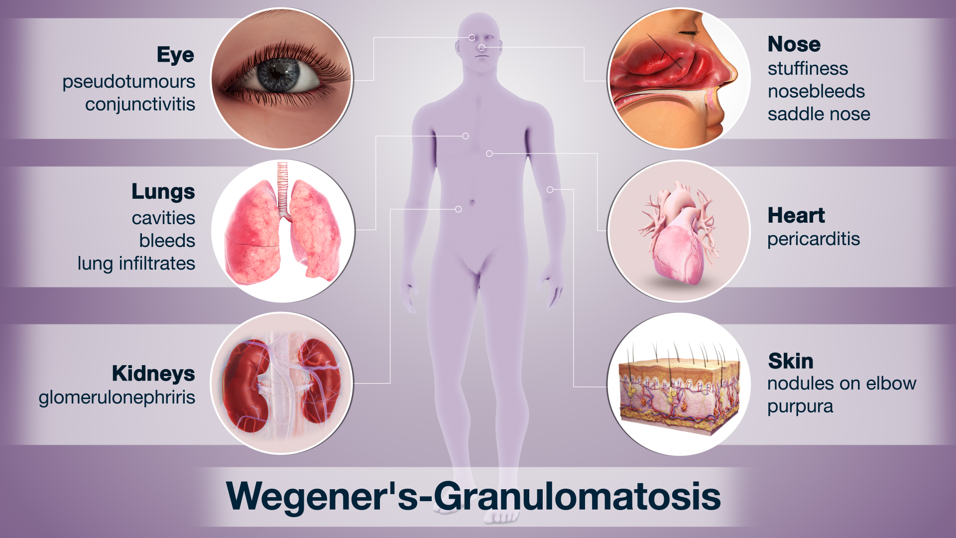 Wegner's Granulomatosis shown & explained using medical animation still