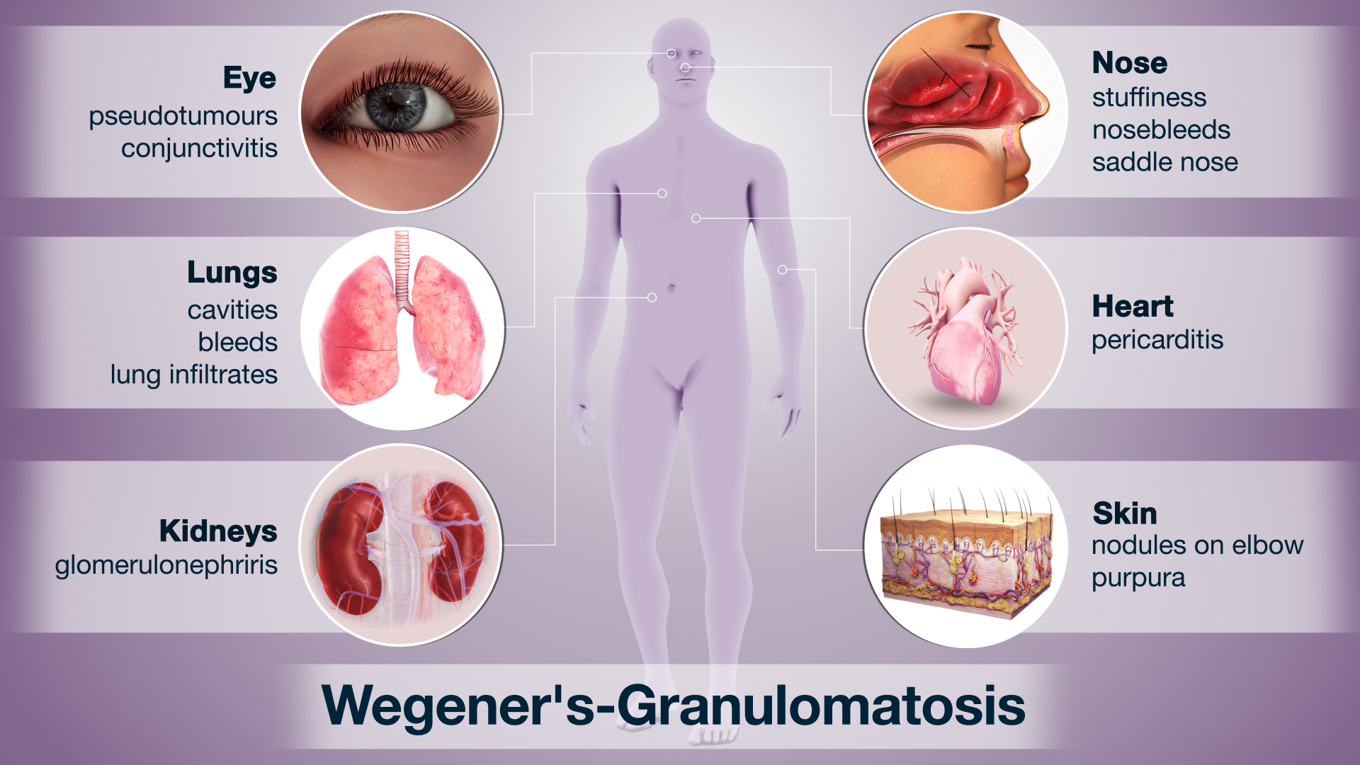 Wegener's-Granulomatosis Shown Using Medical Animation Still Shot