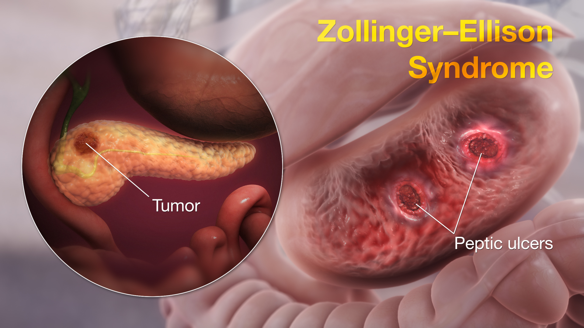 Zollinger-Ellison Syndrome shown using medical animation still shot