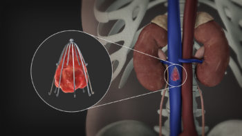 3D Medical Animation Inferior Vena Filter