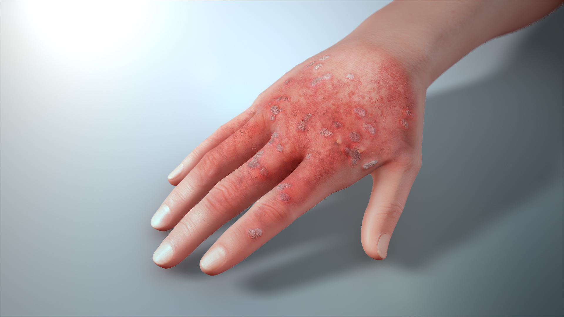 3D Medical Animation Still Shot Depicting Actinic Keratosis