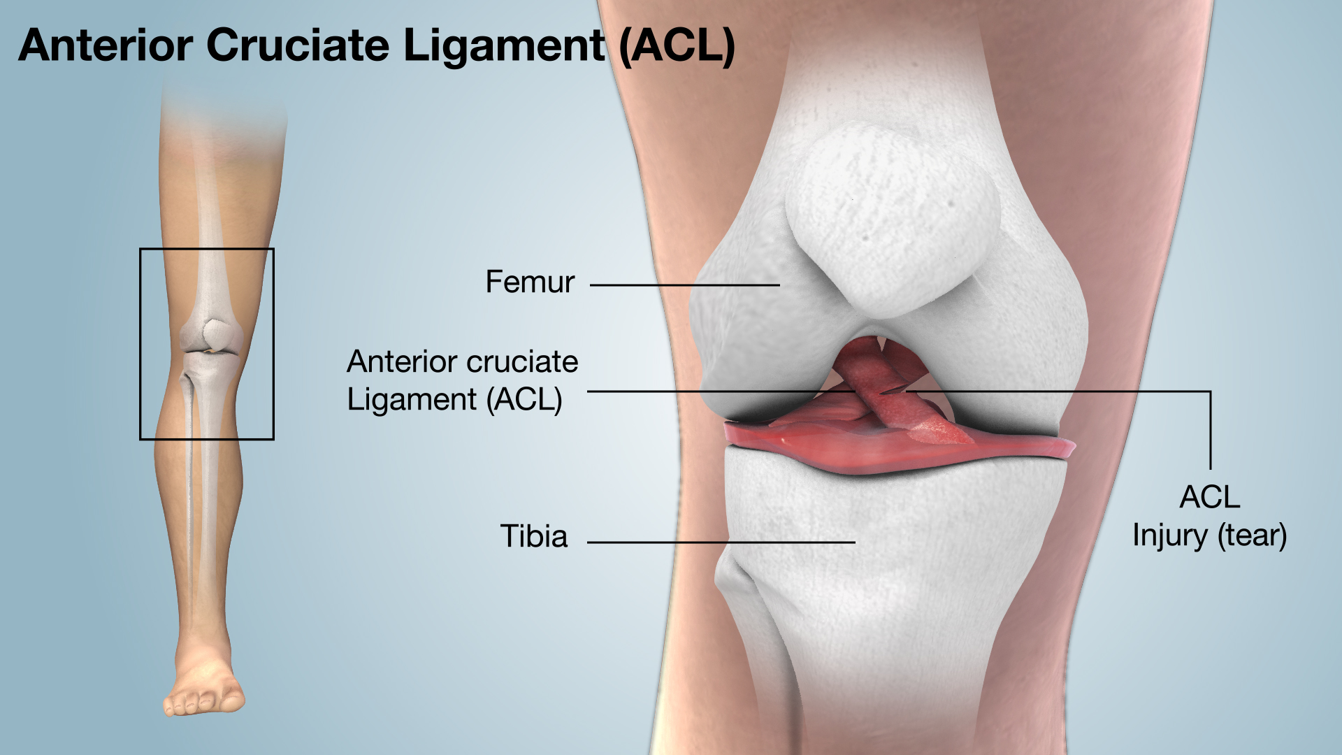 ACL Injury Shown and Explained Using 3D Medical Animation Still Shot